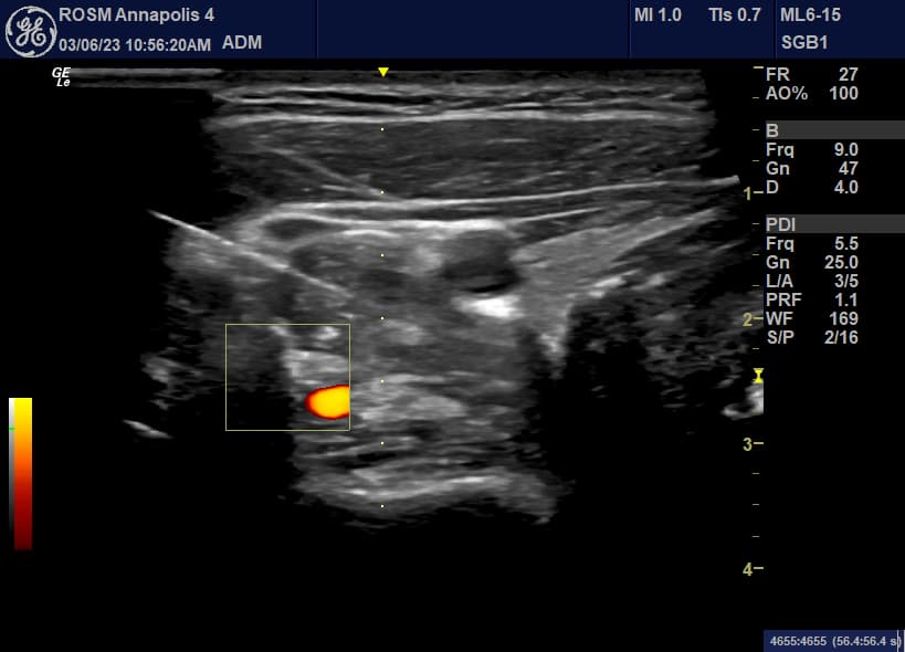 Ultrasound-guided SGB procedure